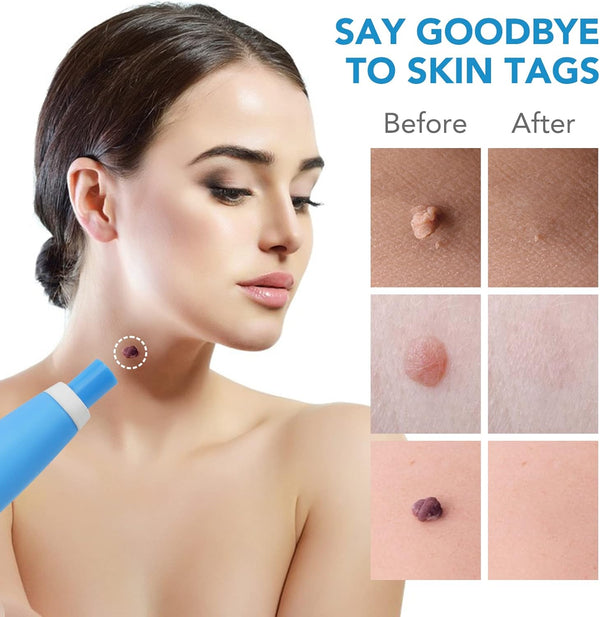 Eliminator Veruci Simplu